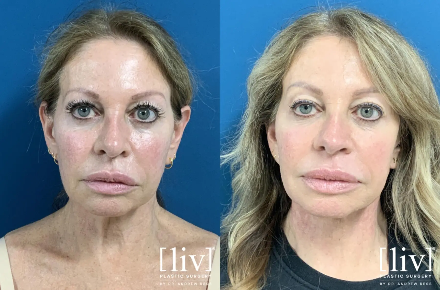 Neck Lift with CO2 Laser  - Before and After 2