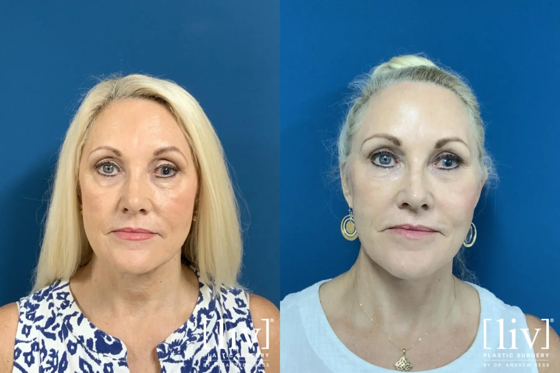 Facelift & Neck Lift: Patient 6 - Before and After 1