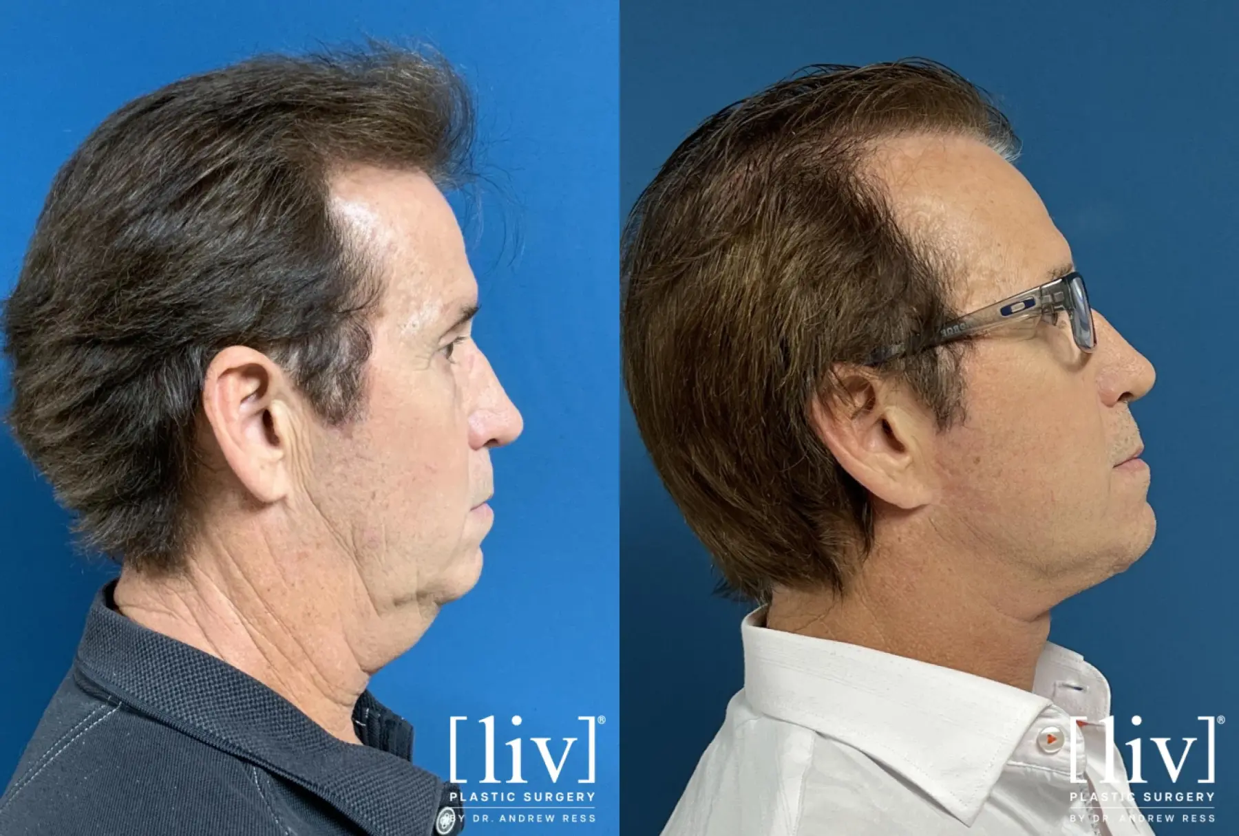 Neck Lift  - Before and After 1