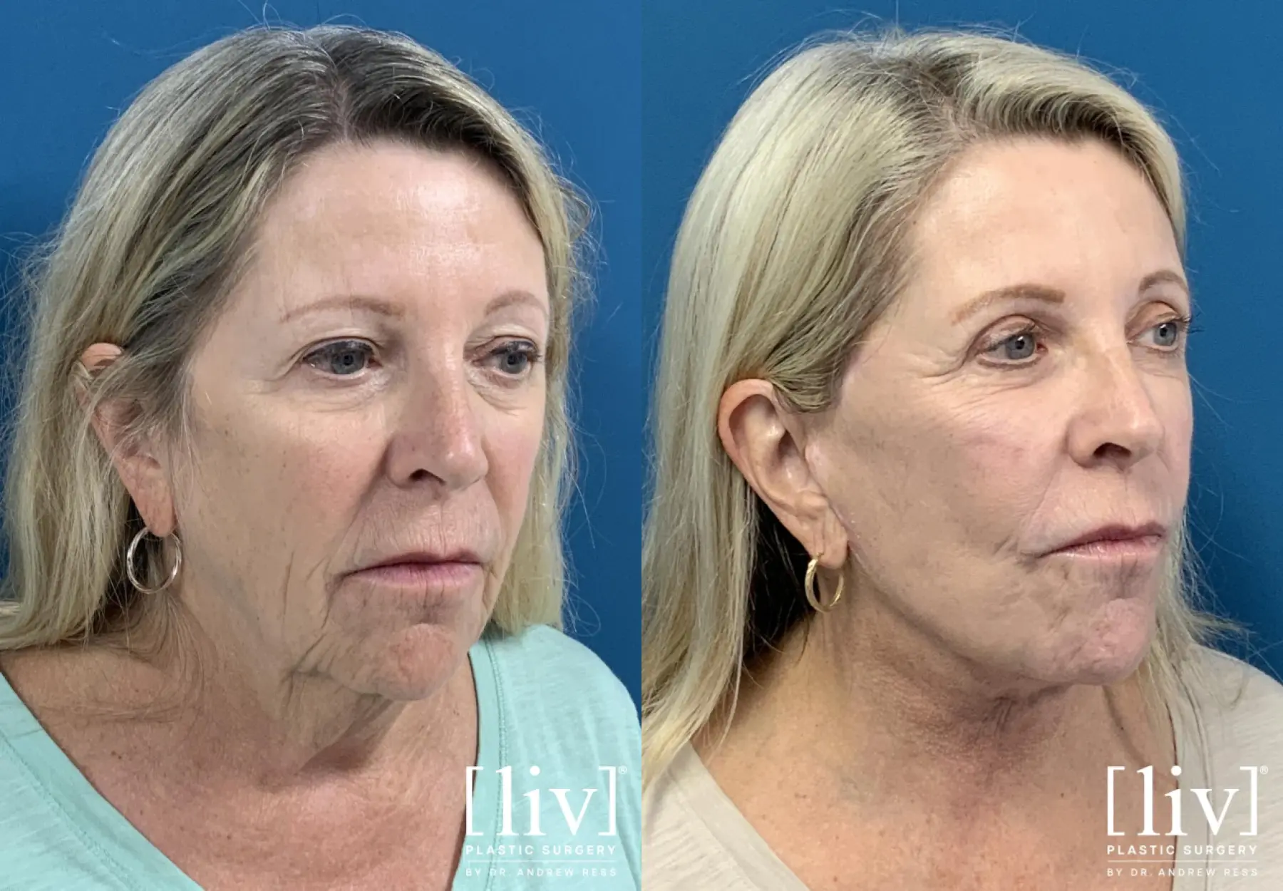 Face and Neck Lift, Co2 Laser, Fat Transfer, Upper Eyelid - Before and After 2