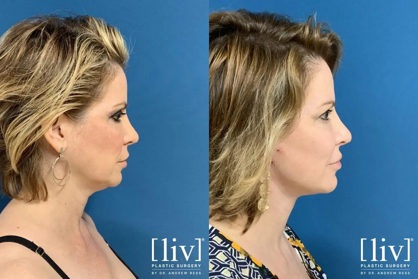 Facelift & Neck Lift: Patient 1 - Before and After 5