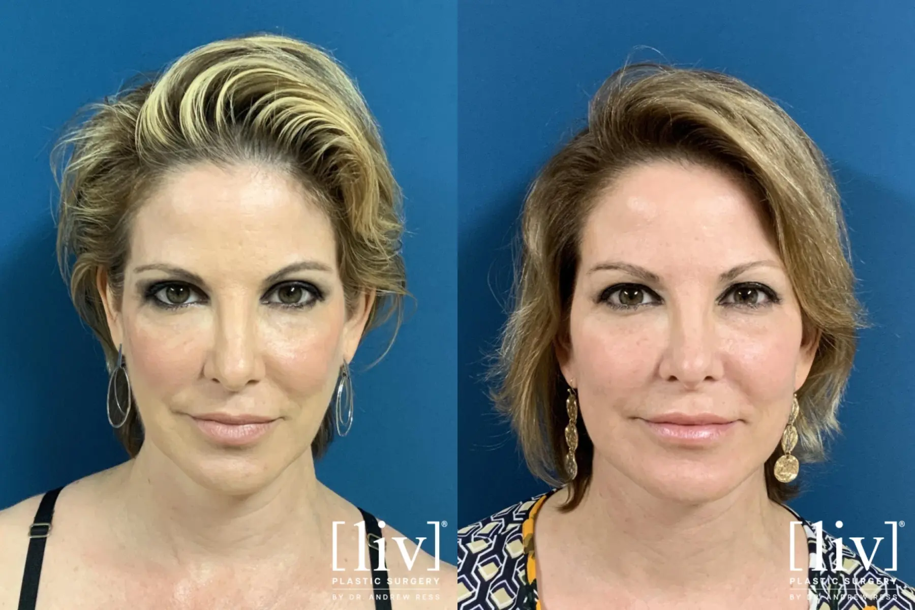 Facelift & Neck Lift: Patient 1 - Before and After  