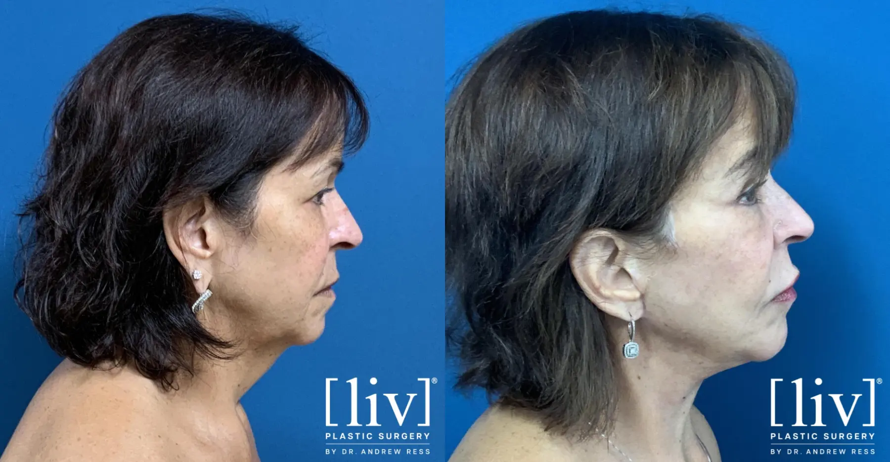 Facelift & Neck Lift: Patient 10 - Before and After 5