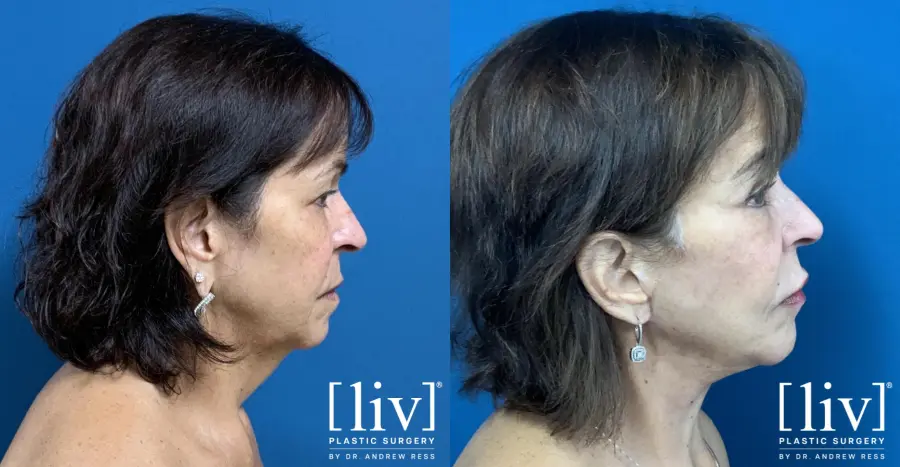 Facelift & Neck Lift: Patient 15 - Before and After 5