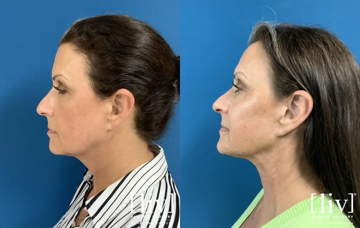 Facelift & Neck Lift: Patient 5 - Before and After 3