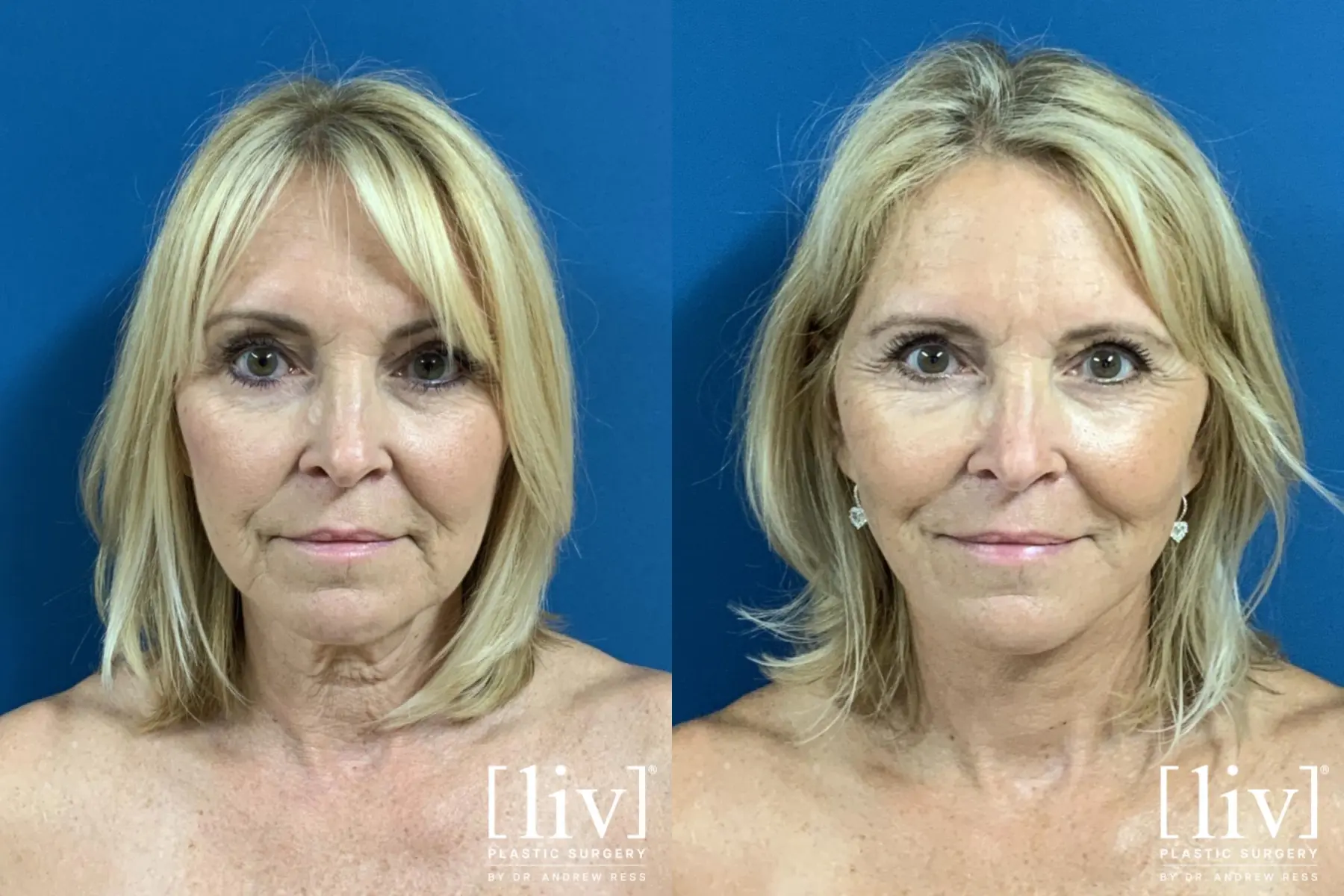 Facelift & Neck Lift: Patient 3 - Before and After  