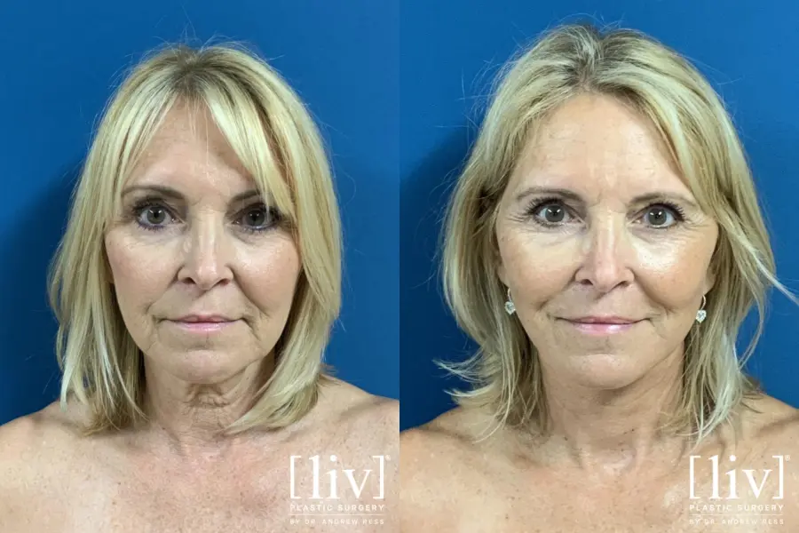 Facelift & Neck Lift: Patient 3 - Before and After 1