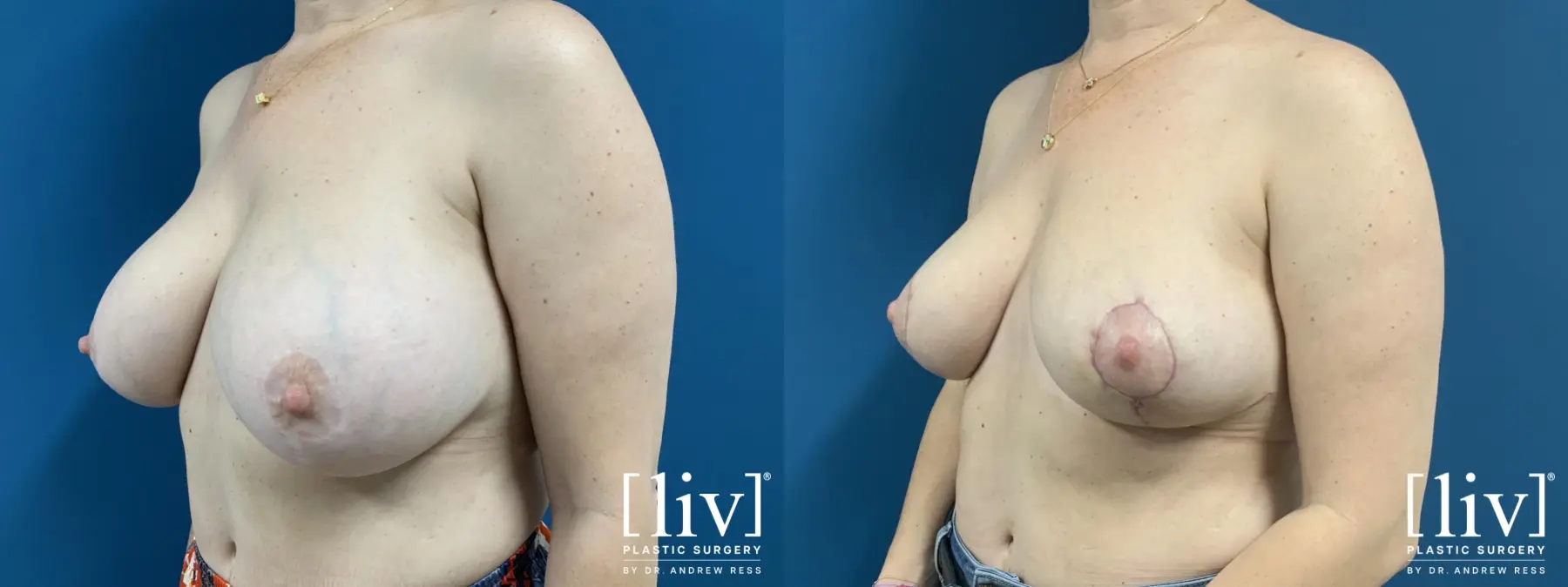 Implant removal with Breast Lift and Fat Transfer to Breast  - Before and After 2