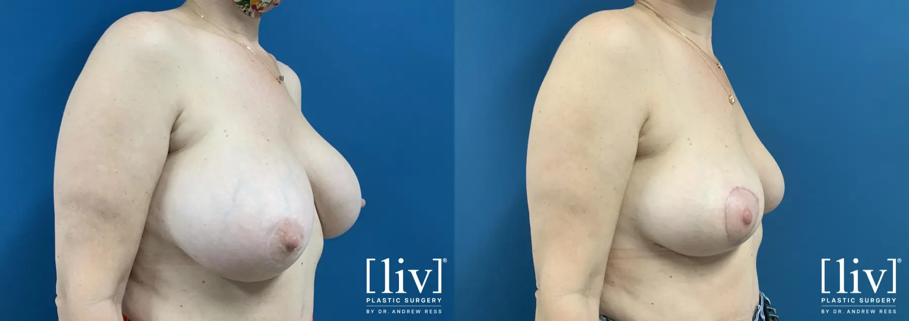 Implant removal with Breast Lift and Fat Transfer to Breast  - Before and After 4