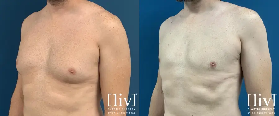 Gynecomastia: Patient 6 - Before and After 2