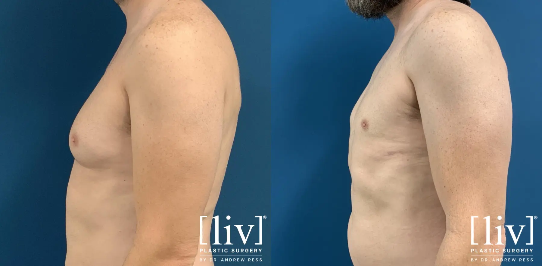 Gynecomastia: Patient 6 - Before and After 3