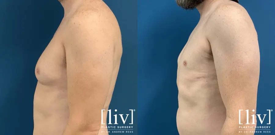 Gynecomastia: Patient 6 - Before and After 3