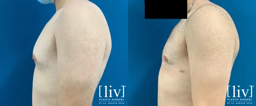 Gynecomastia: Patient 4 - Before and After 2