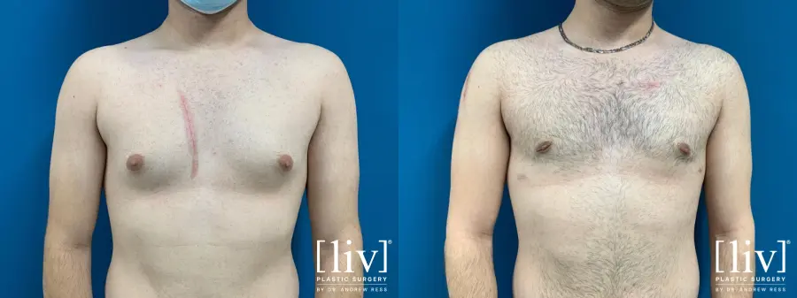 Gynecomastia: Patient 4 - Before and After  