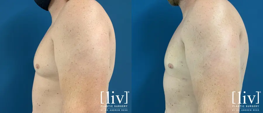Gynecomastia: Patient 5 - Before and After  