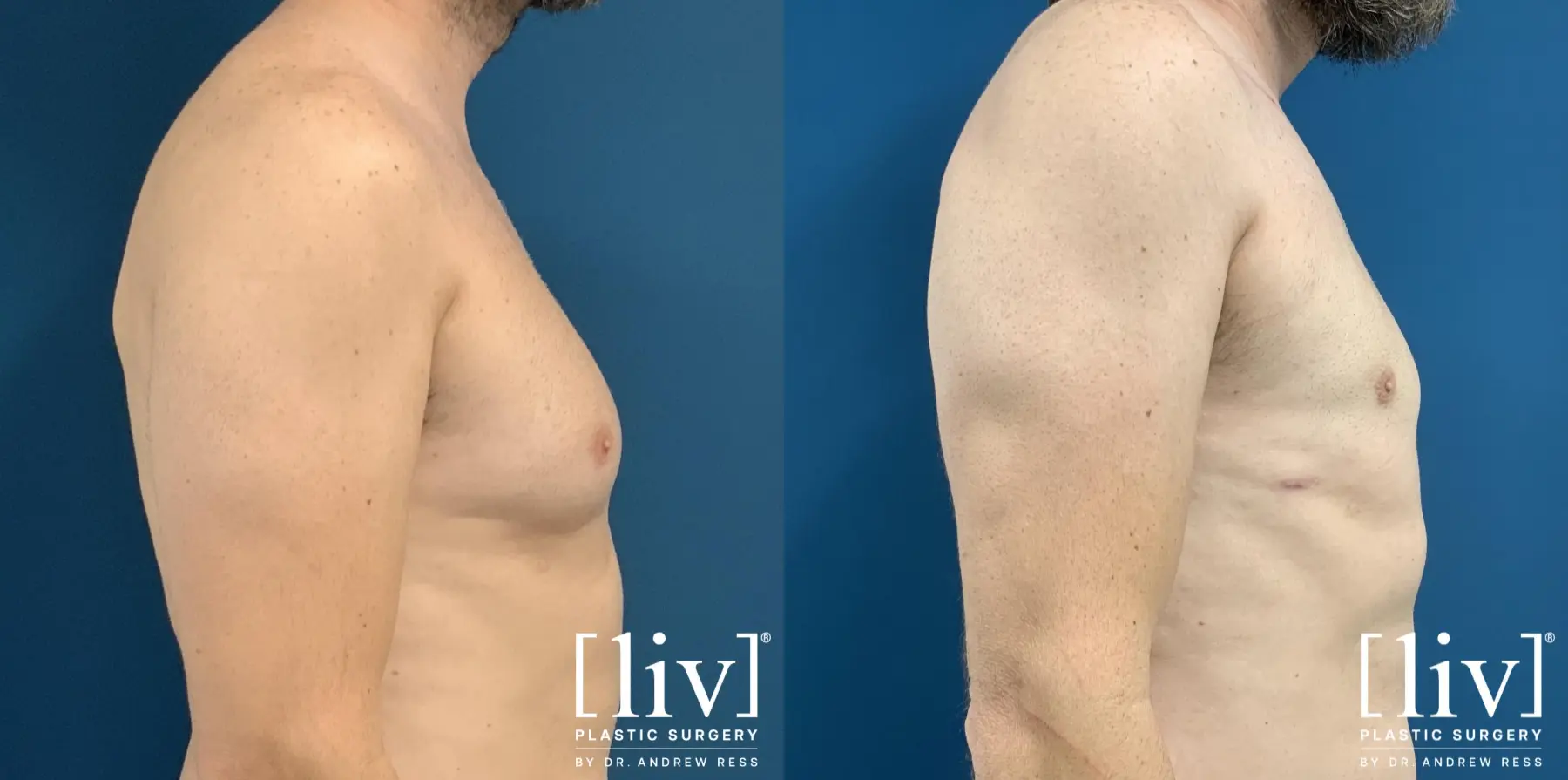 Gynecomastia: Patient 6 - Before and After 5