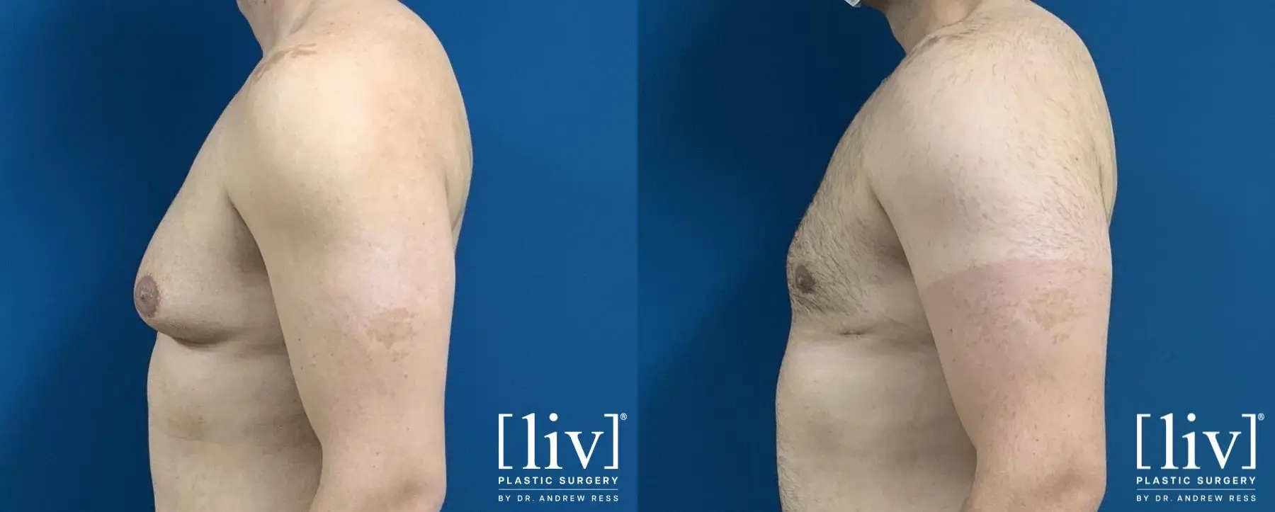 Gynecomastia: Patient 1 - Before and After 3