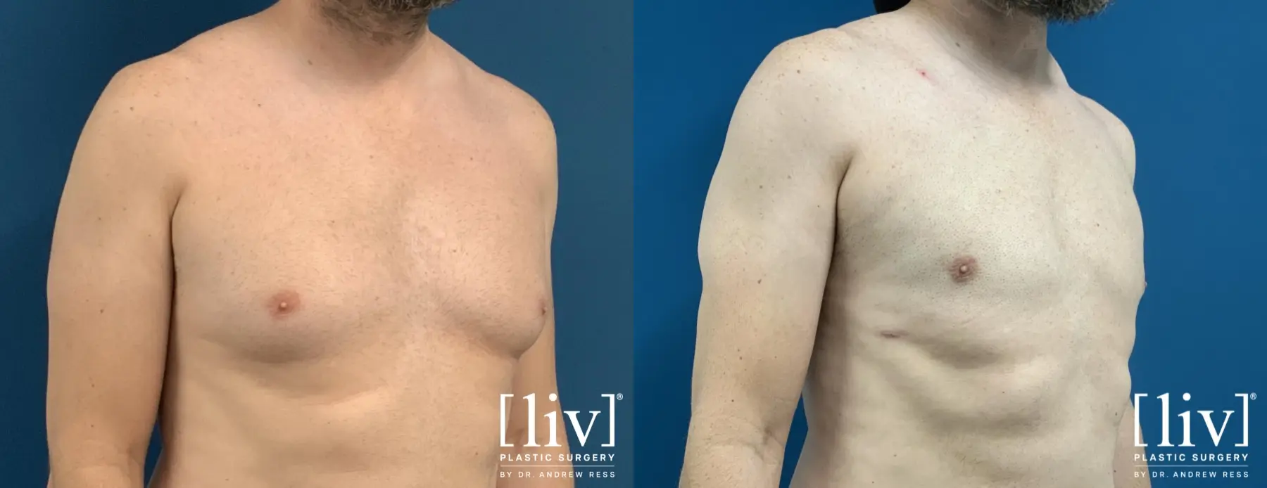 Gynecomastia: Patient 6 - Before and After 4