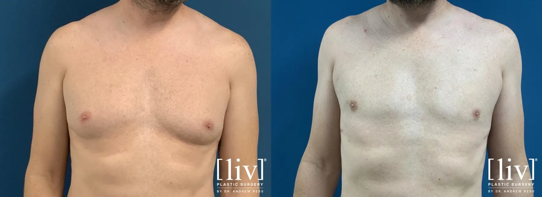 Gynecomastia: Patient 6 - Before and After 1