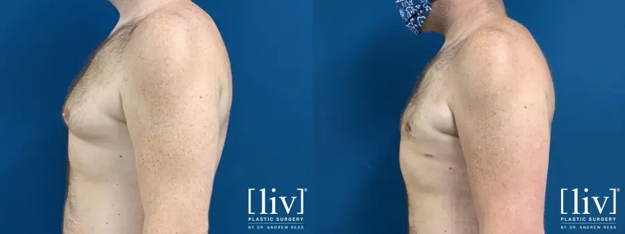 Gynecomastia: Patient 2 - Before and After 3