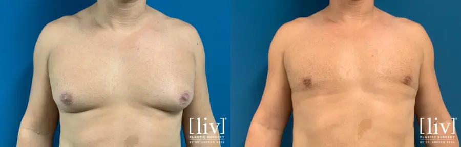 Gynecomastia: Patient 3 - Before and After 1