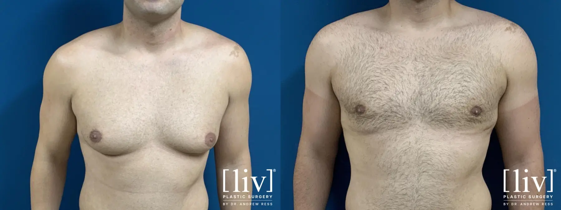 Gynecomastia: Patient 1 - Before and After 1