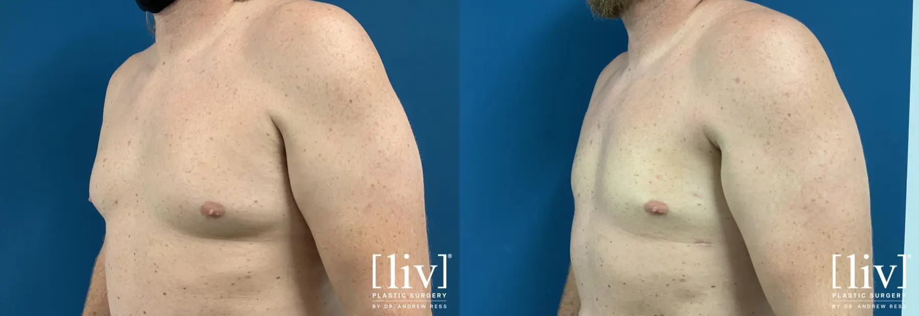 Gynecomastia: Patient 5 - Before and After 2