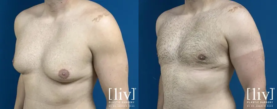 Gynecomastia: Patient 1 - Before and After 2