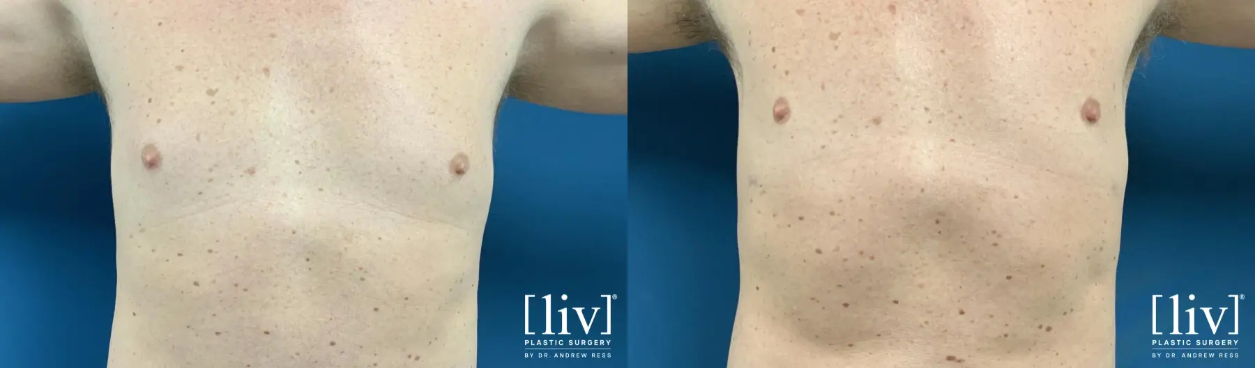 Gynecomastia: Patient 5 - Before and After 3