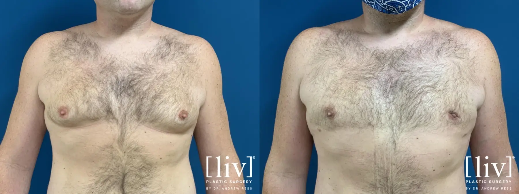 Gynecomastia: Patient 2 - Before and After 1