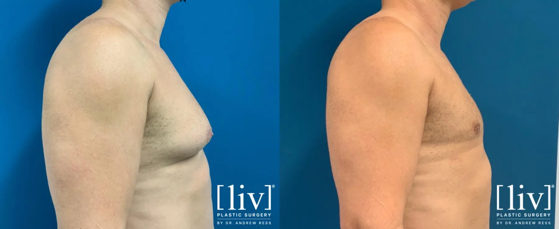 Gynecomastia: Patient 3 - Before and After 2