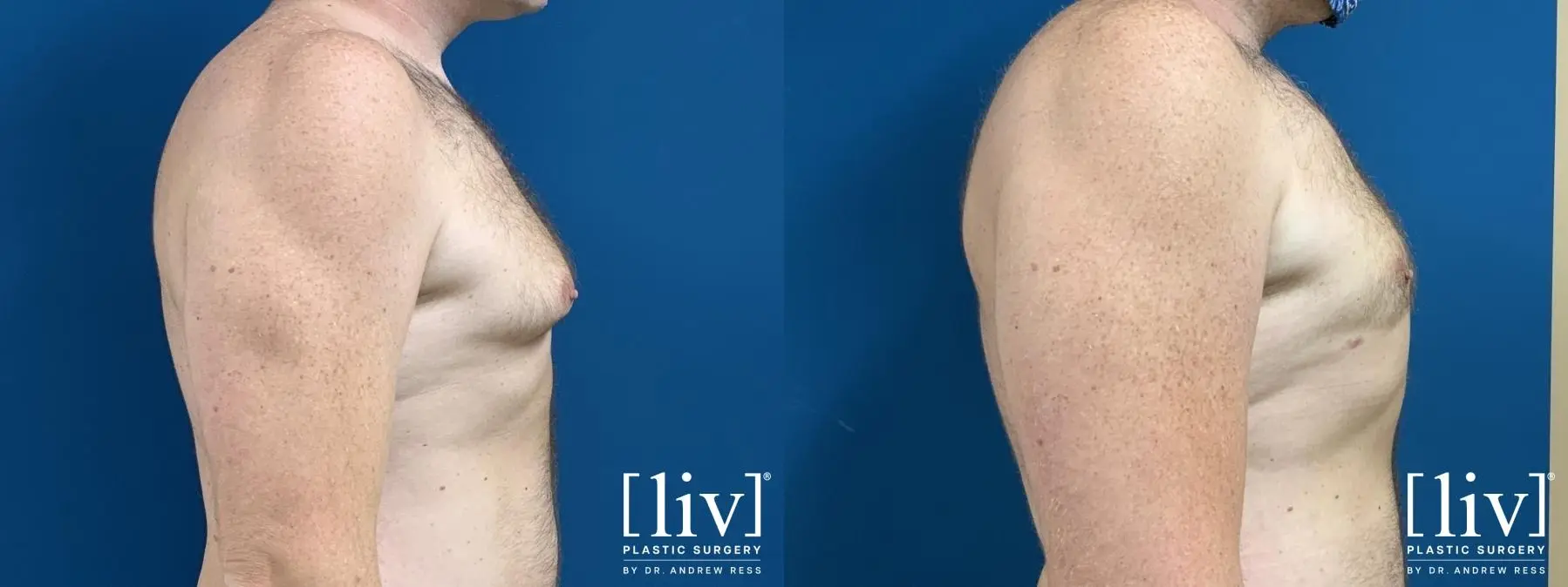 Gynecomastia: Patient 2 - Before and After 2