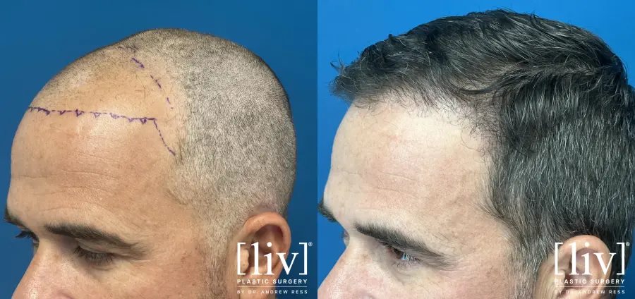 Hair Transplantation: Patient 1 - Before and After 2
