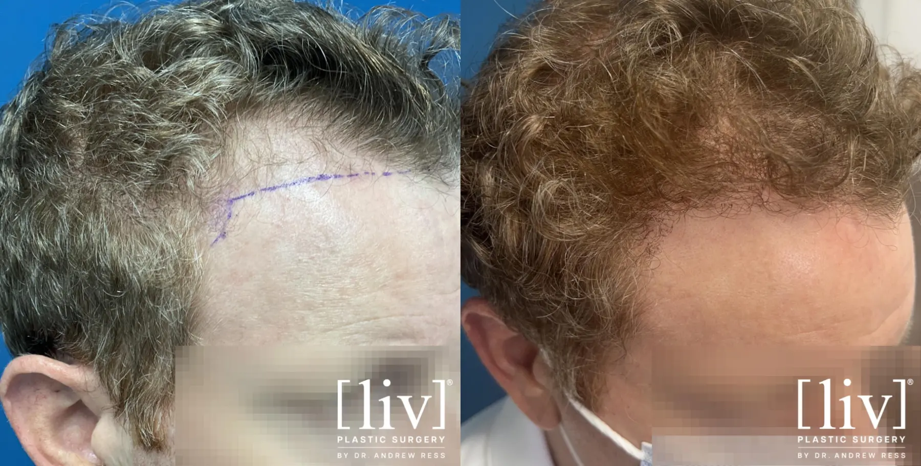 Hair Transplantation: Patient 12 - Before and After 2