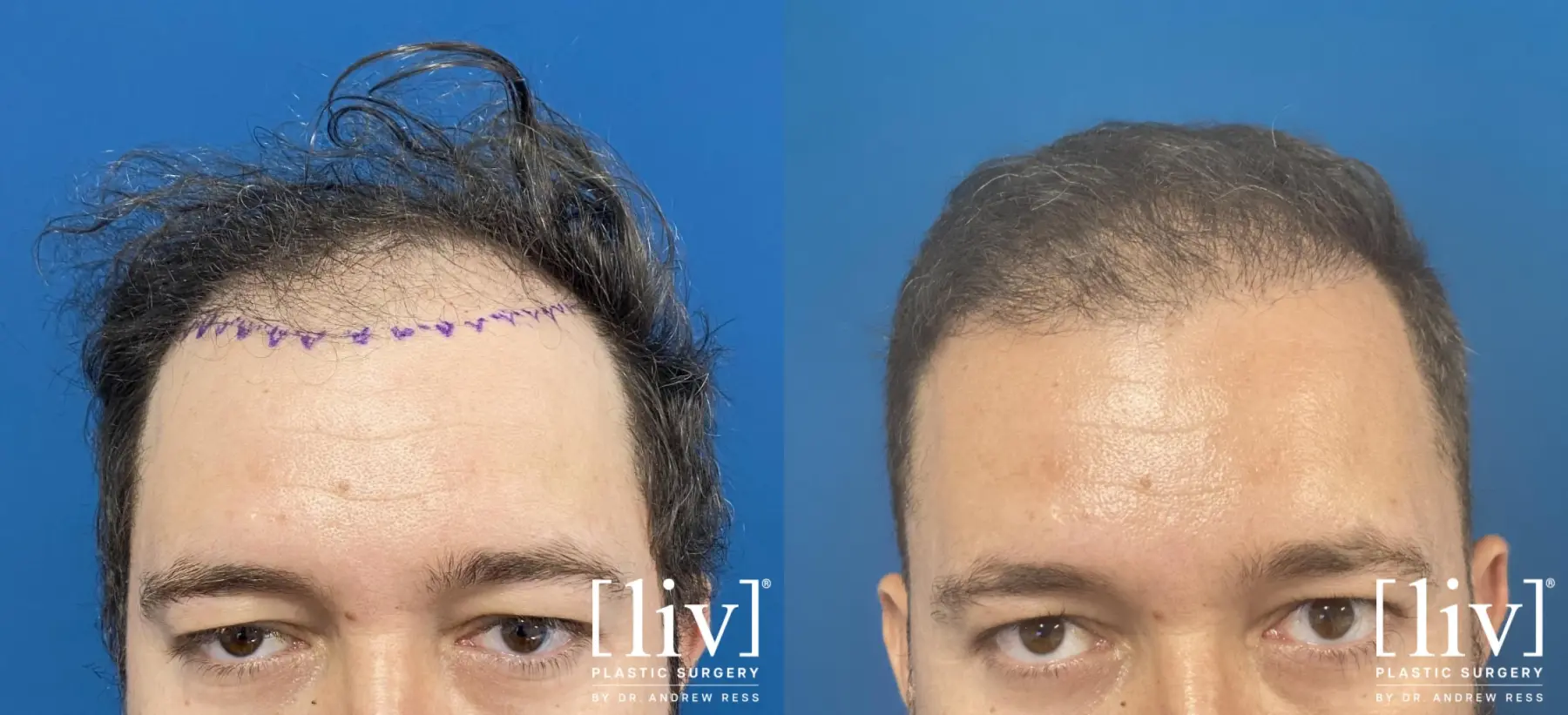 Hair Transplantation: Patient 9 - Before and After 1