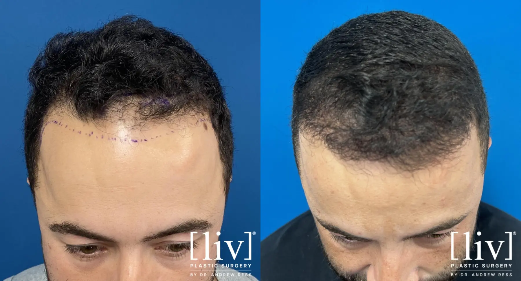Hair Transplantation: Patient 10 - Before and After 1