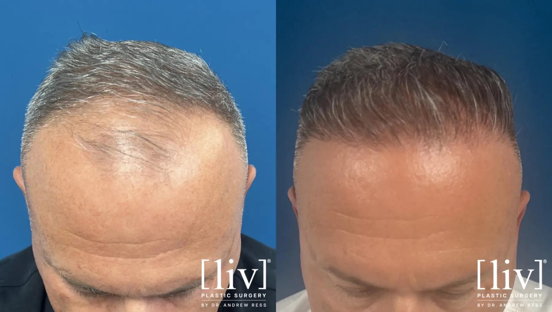Hair Transplantation: Patient 15 - Before and After 1