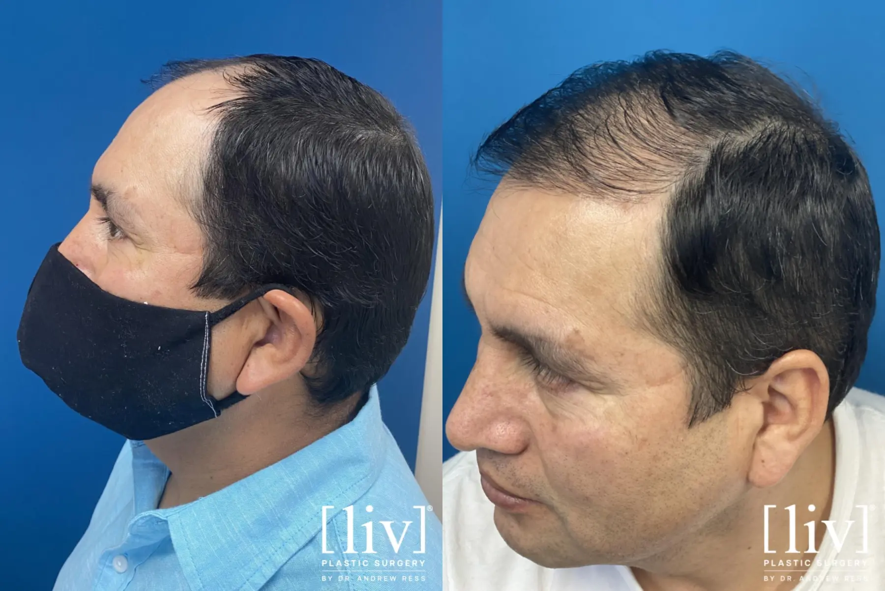 Hair Transplantation: Patient 1 - Before and After 2