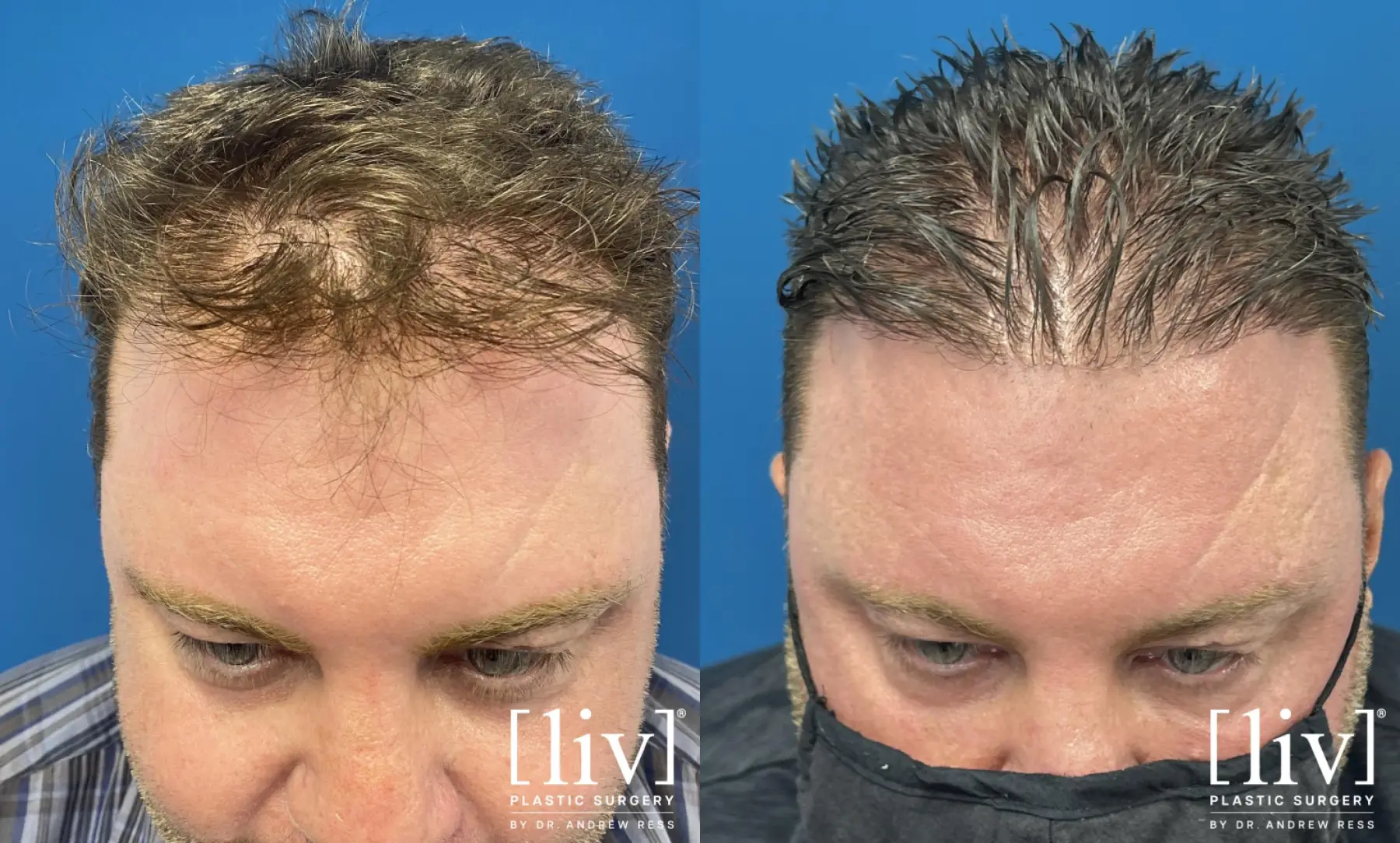 Hair Transplantation: Patient 11 - Before and After 1
