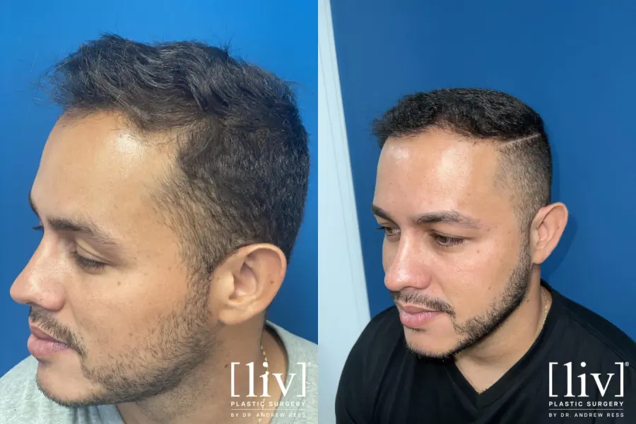 Hair Transplantation: Patient 3 - Before and After 2