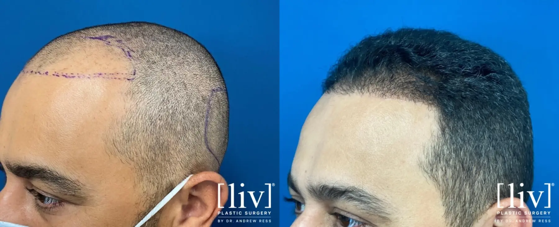 FUE Hair Transplant - Before and After 2
