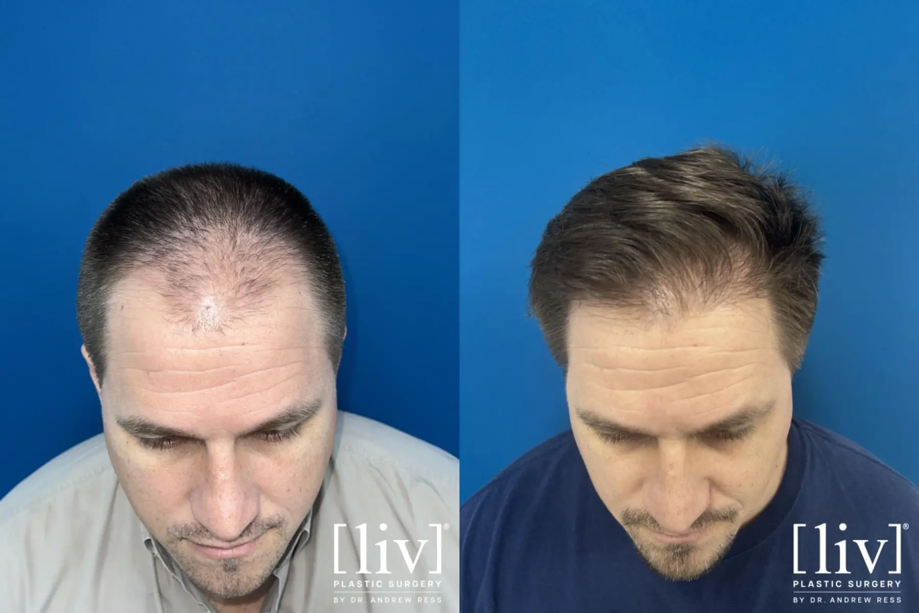 Hair Transplantation: Patient 2 - Before and After 1