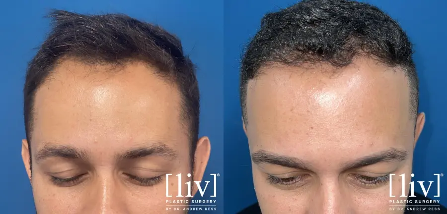 Hair Transplantation: Patient 3 - Before and After 1