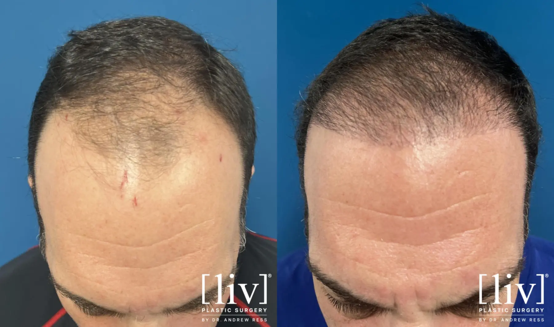 Hair Transplantation: Patient 13 - Before and After 1