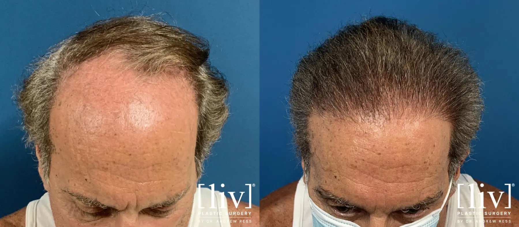 FUE Hair Transplant - Before and After 1