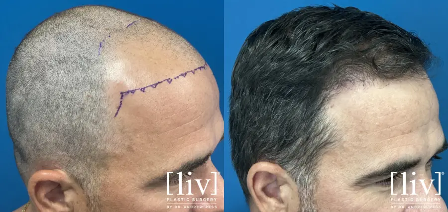 Hair Transplantation: Patient 1 - Before and After 3