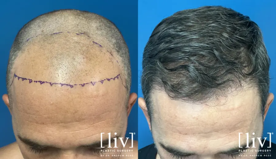 Hair Transplantation: Patient 1 - Before and After 1