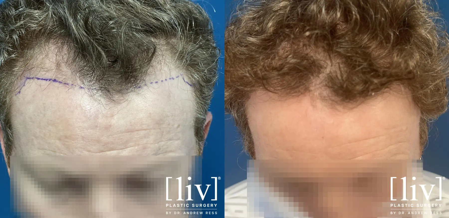 Hair Transplantation: Patient 12 - Before and After 1