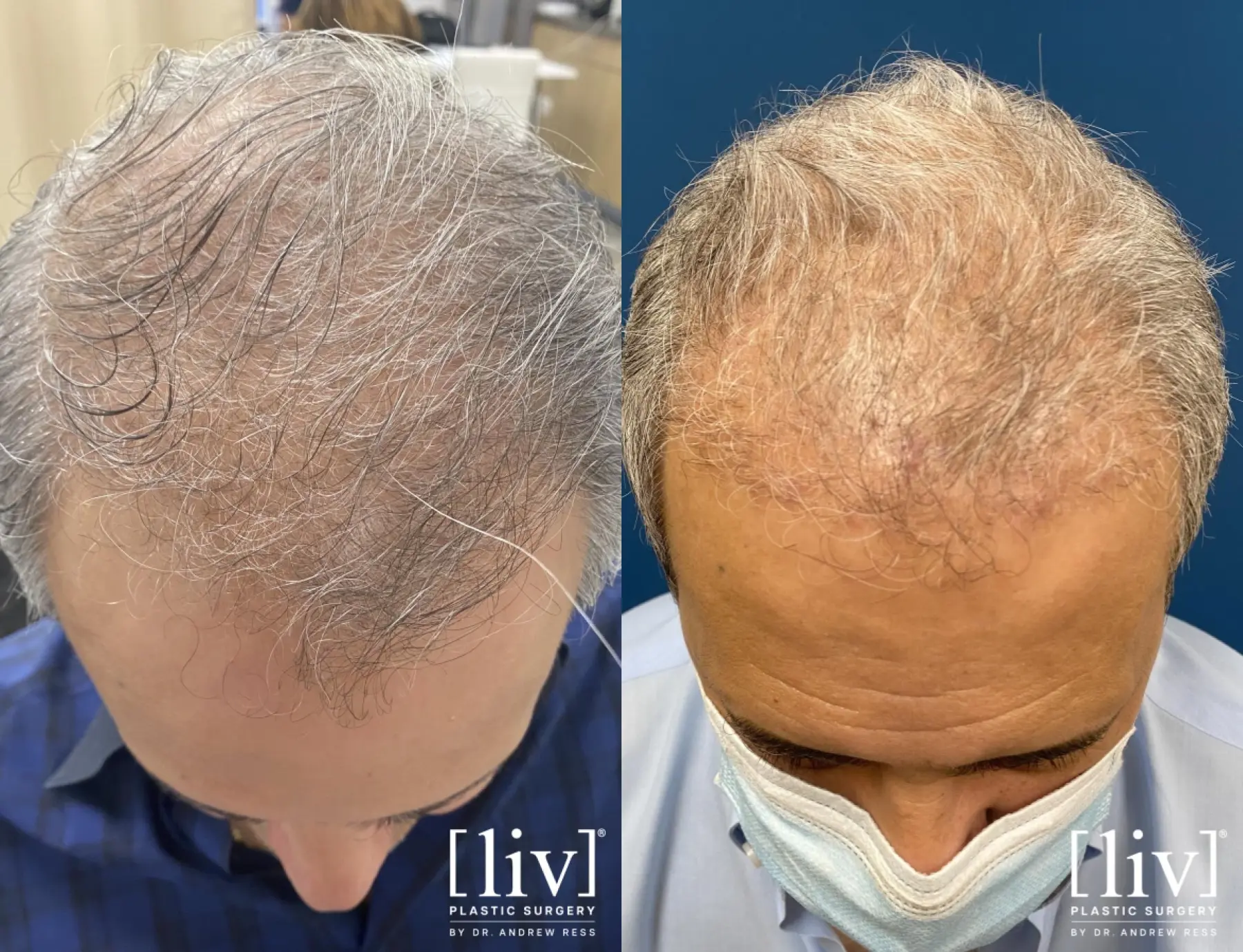 Hair Transplantation: Patient 8 - Before and After 1