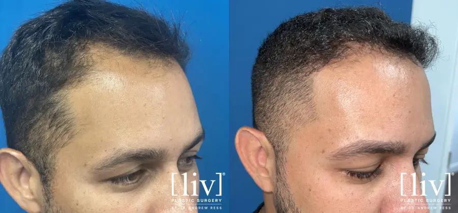 Hair Transplantation: Patient 3 - Before and After 3